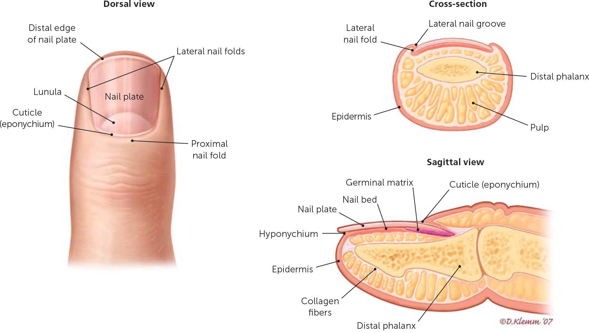 Subungual Exostosis | MDedge Dermatology