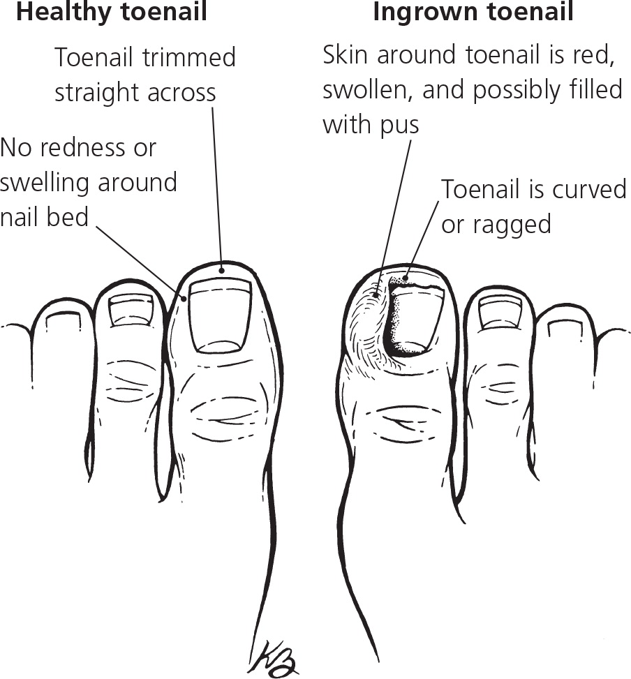 Defectiune precis rigla ingrown toenail removal at home handicapat ...