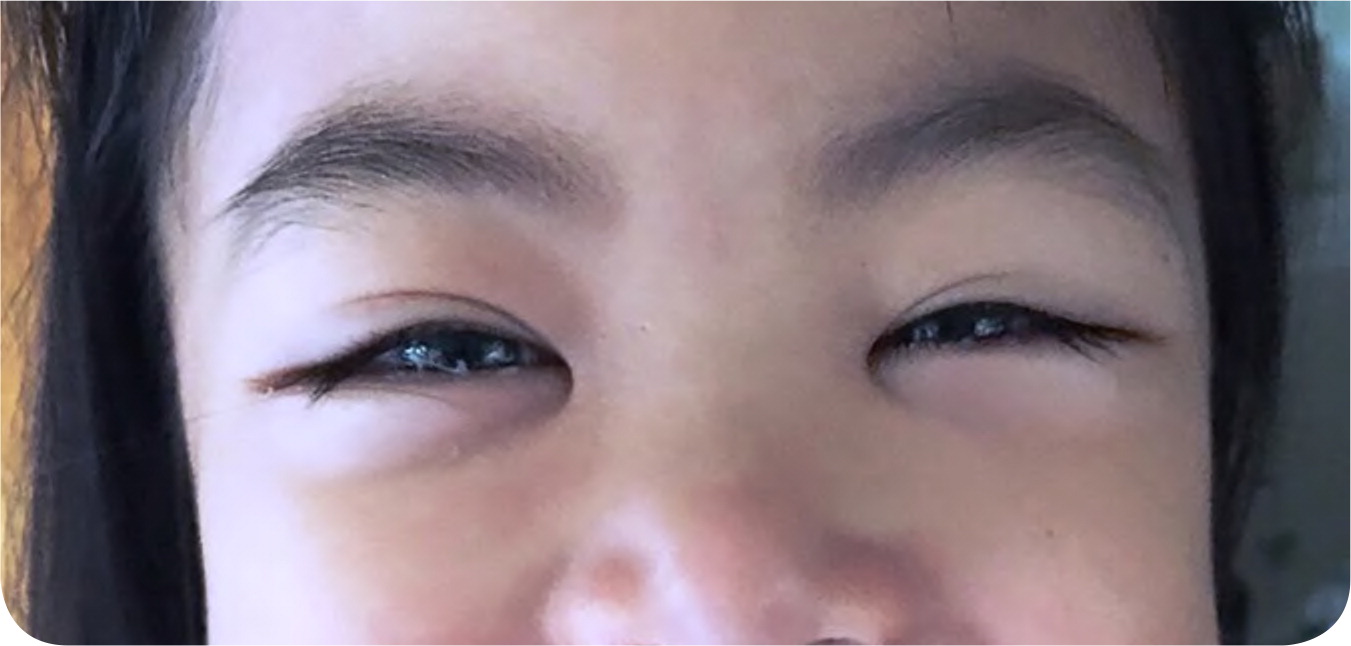 What Causes Dark Circles Under Kids' Eyes, According to Science