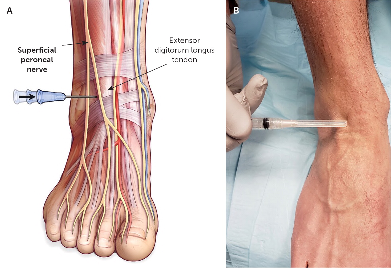 Нейропатия операция. Superficial Peroneal nerve. Deep Peroneal nerve.