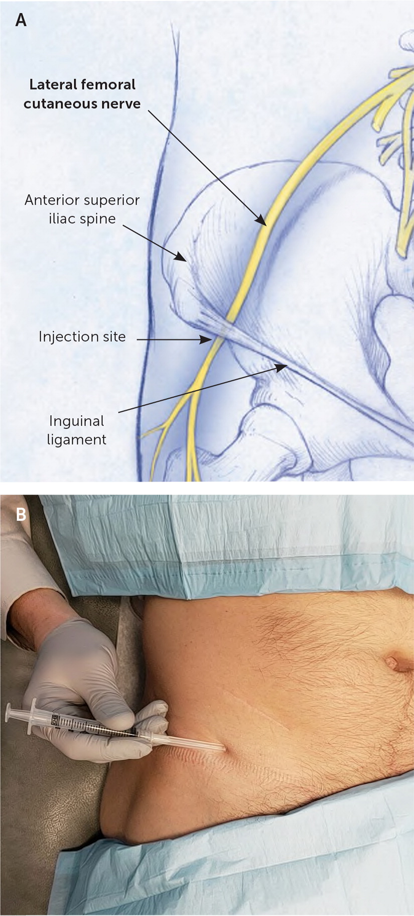 sciatic nerve block anterior approach