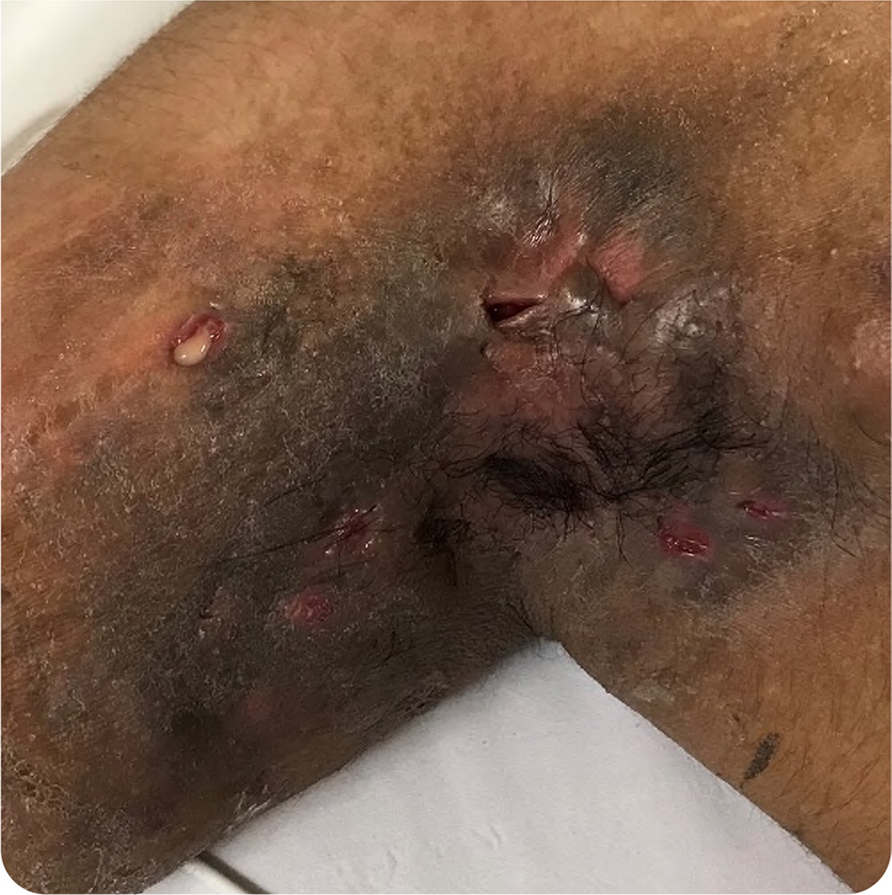 Clinical Challenge: Painful Cysts Affecting Armpit, Groin, and Upper Thighs  - MPR