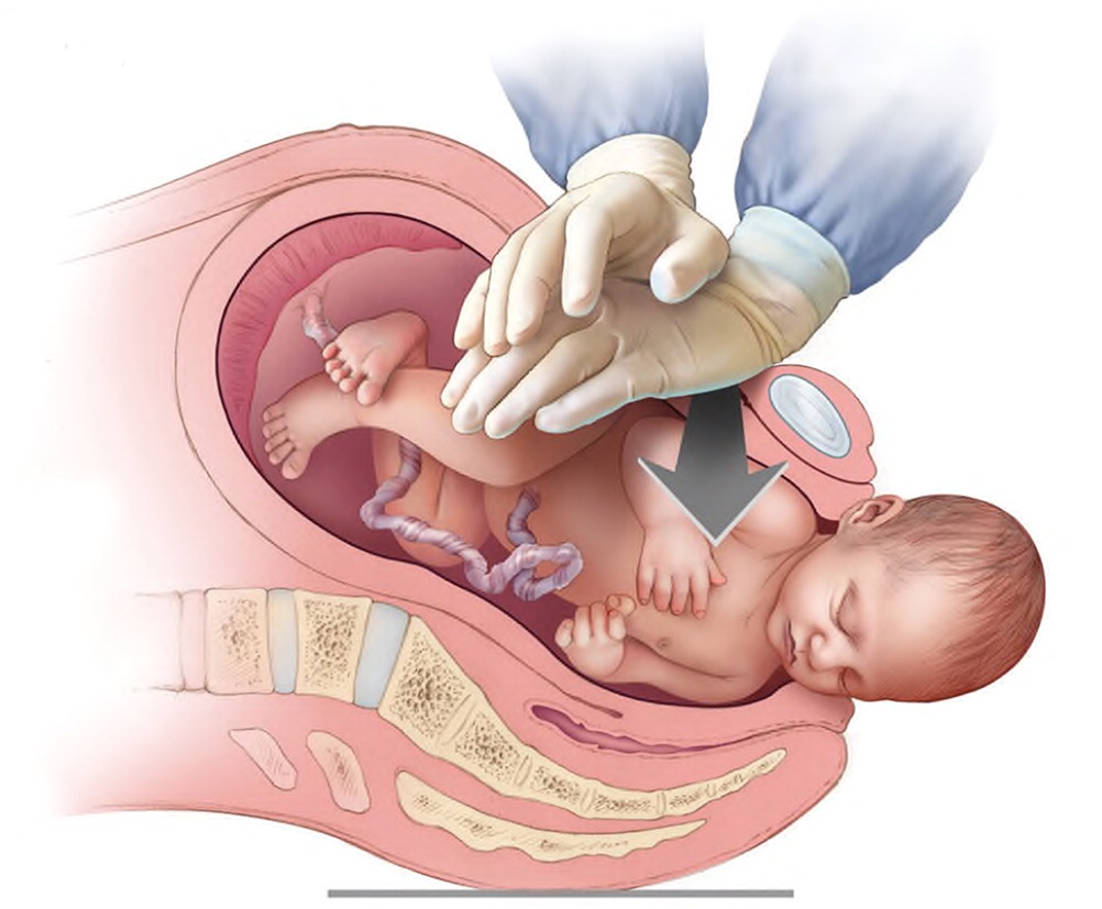 shoulder presentation complications of fetus