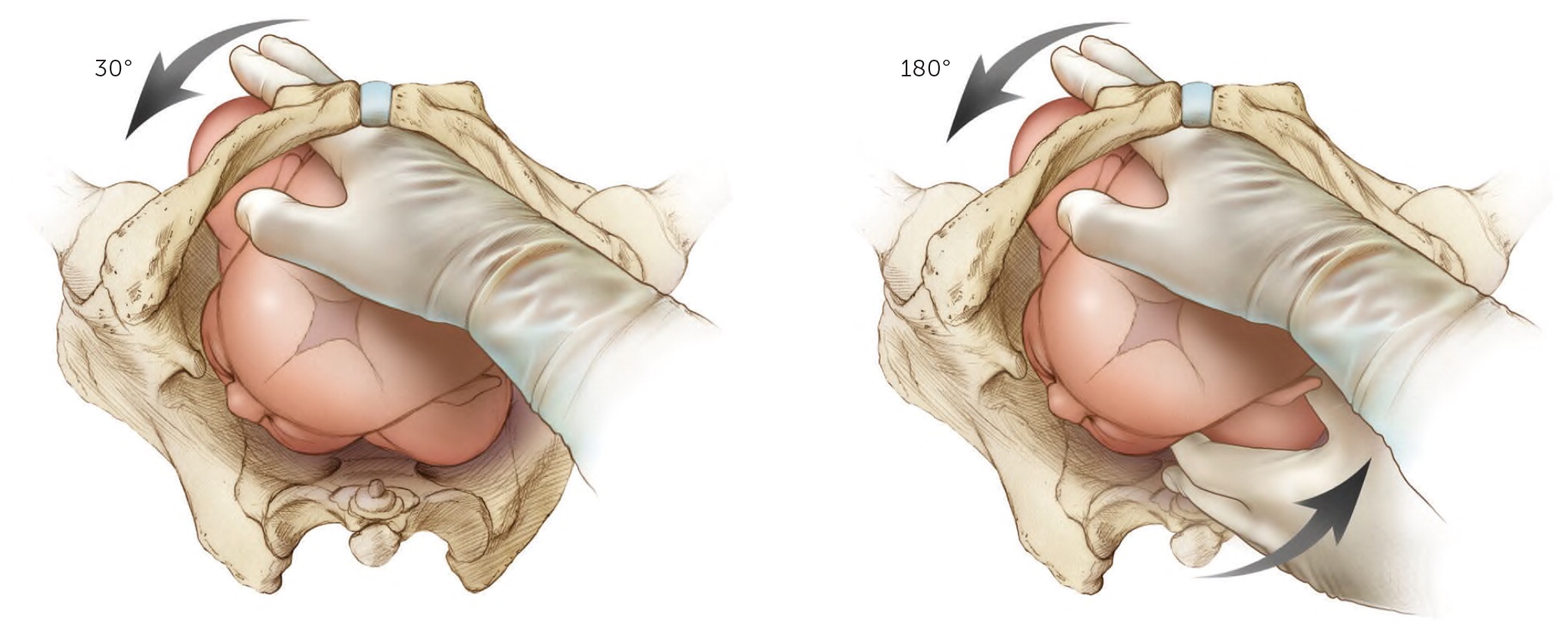 shoulder presentation complications of fetus