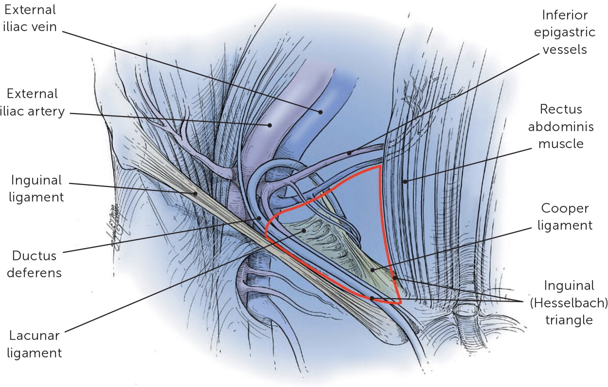 nursing case study on hernia