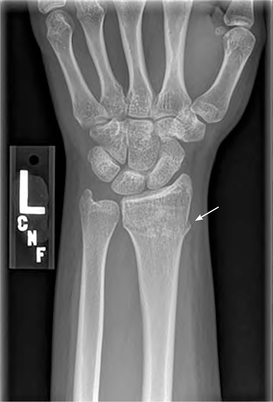 Distal Radius Bone Fracture