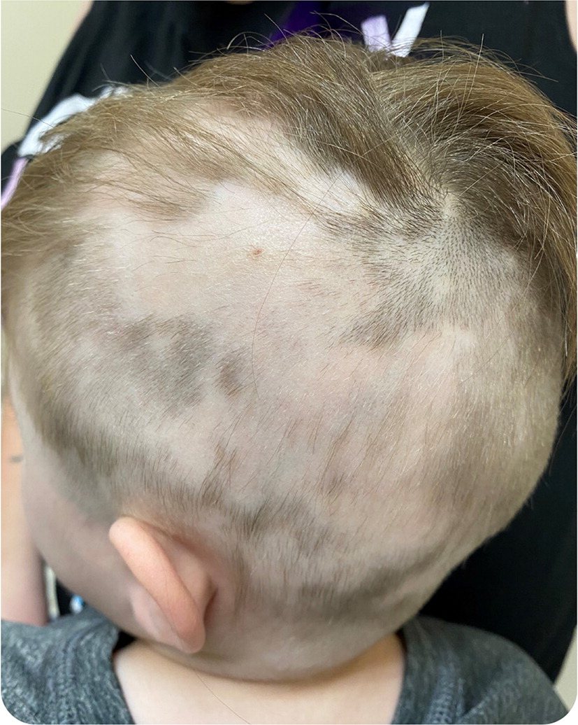 Hair Loss in a Child | AAFP