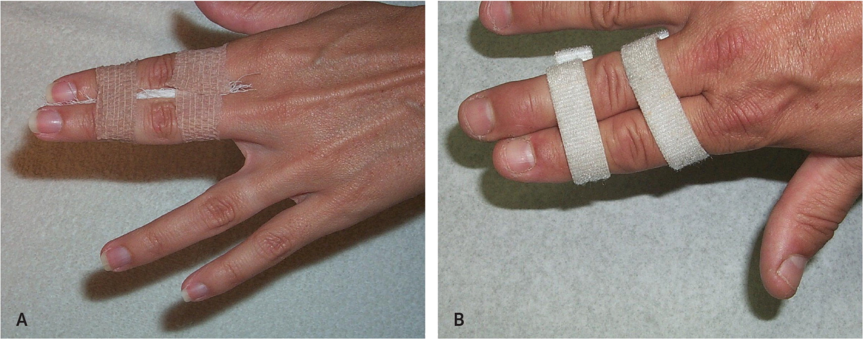 What is a Finger Fracture & How to Handle Such Injuries? - Upswing Health