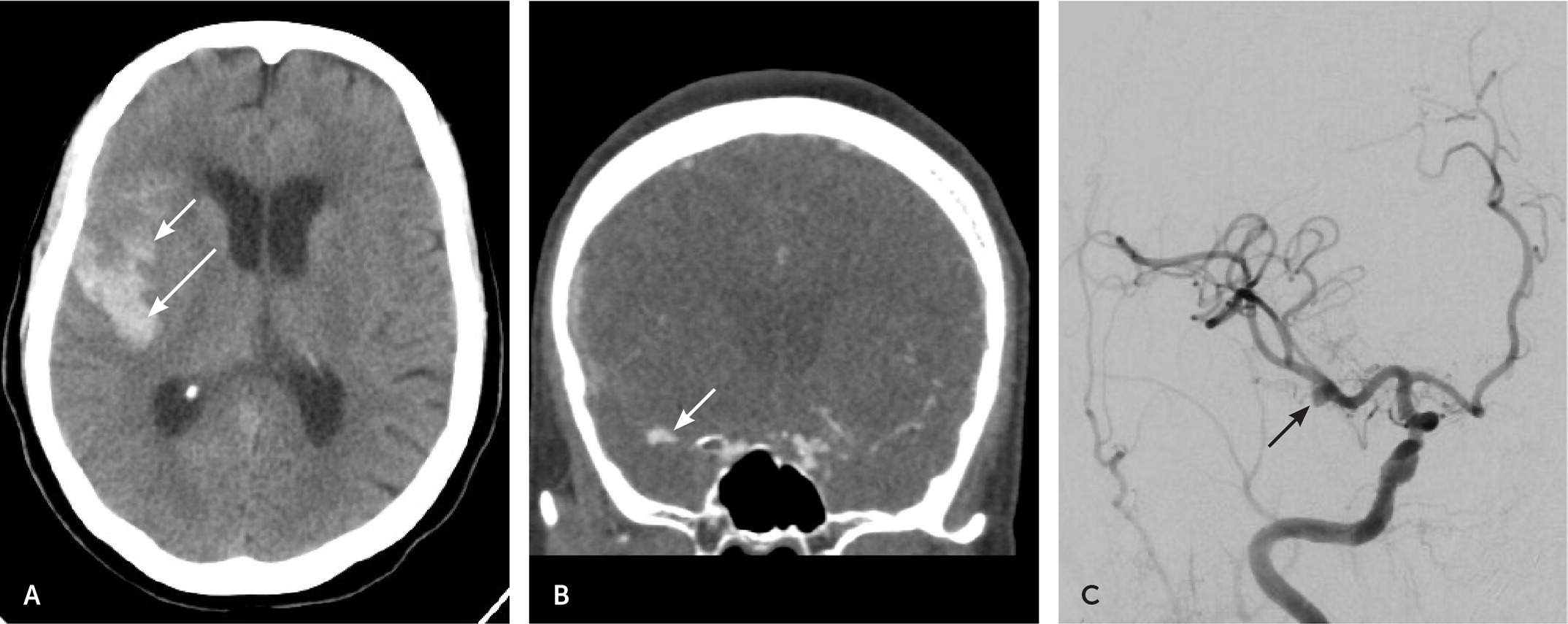 Imaging Evaluation of SAH and Aneurysm