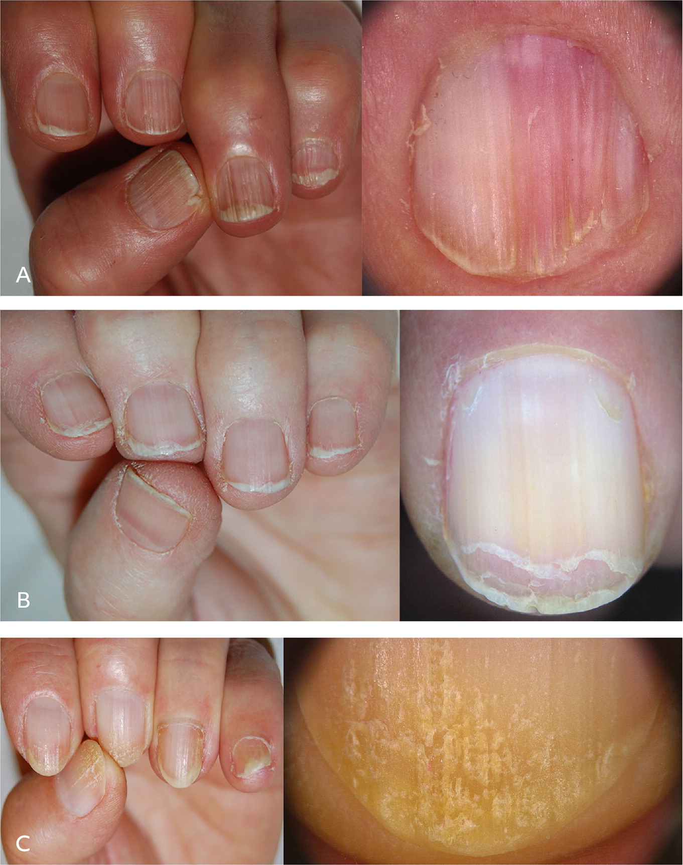 Ridges in Fingernails: Causes, Symptoms, Treatment, Prevention, image size:1361x1723