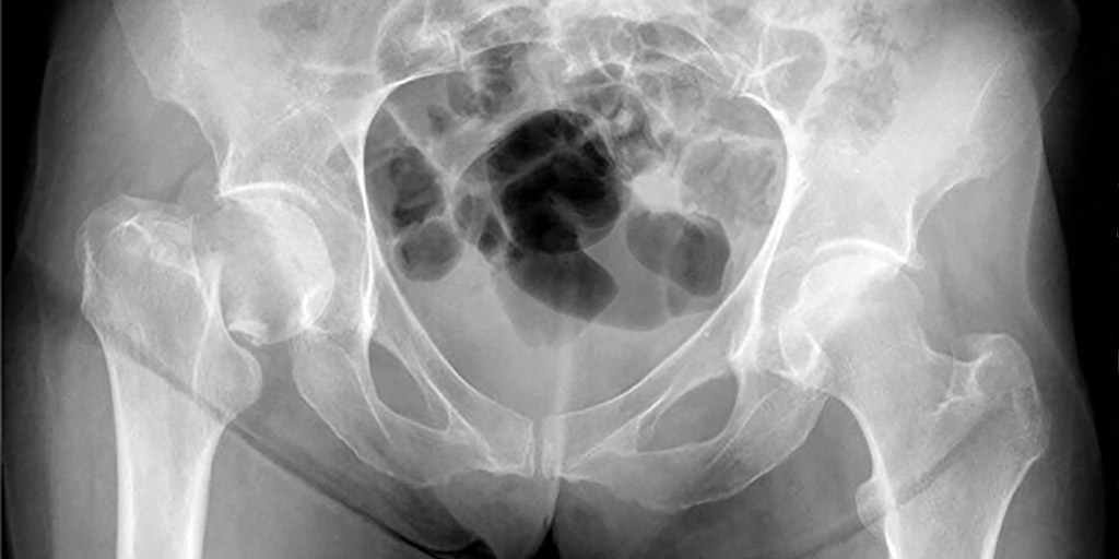 Hip Fractures Diagnosis And Management Aafp