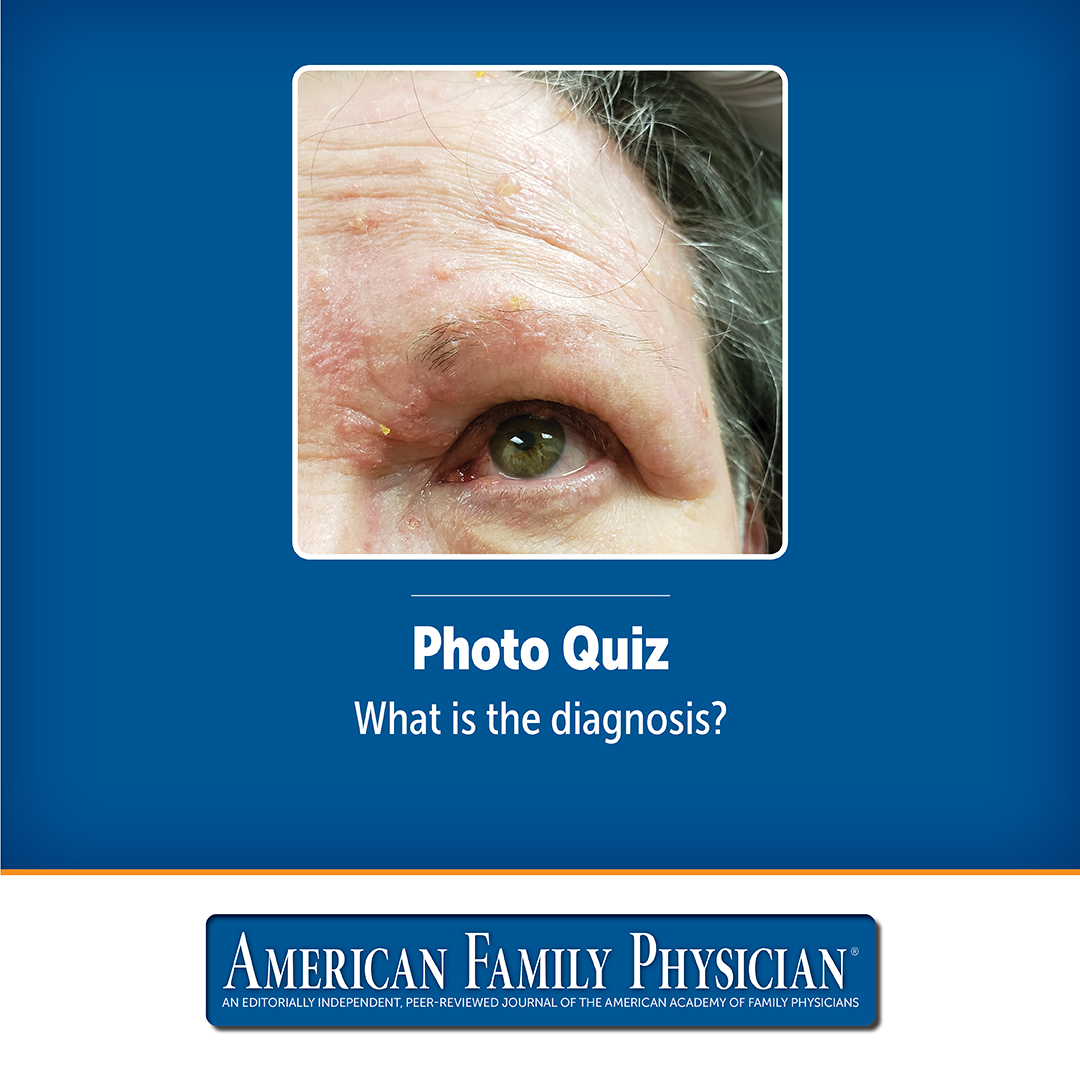 Blurry Vision and Facial Rash | AAFP