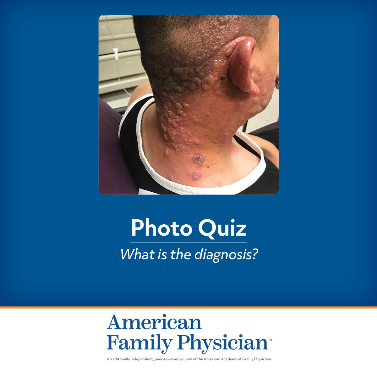 Bullous Rash on the Face and Neck | AAFP